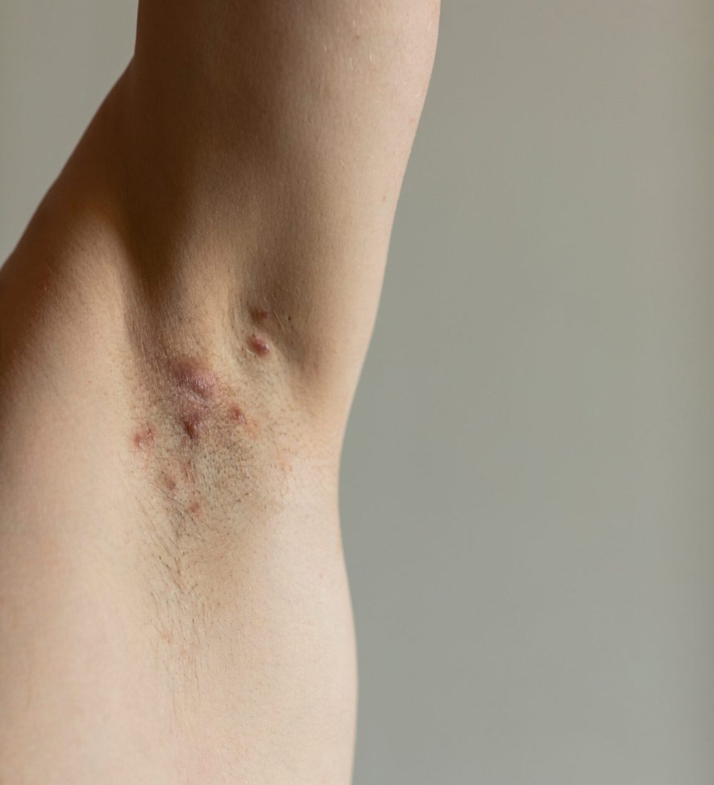 Patient diagnosed with Crohn’s disease with hidradenitis suppurativa under his armit with visible red painful fistulas. Irritated skin and hair follicles, abcess. Close up, vertical