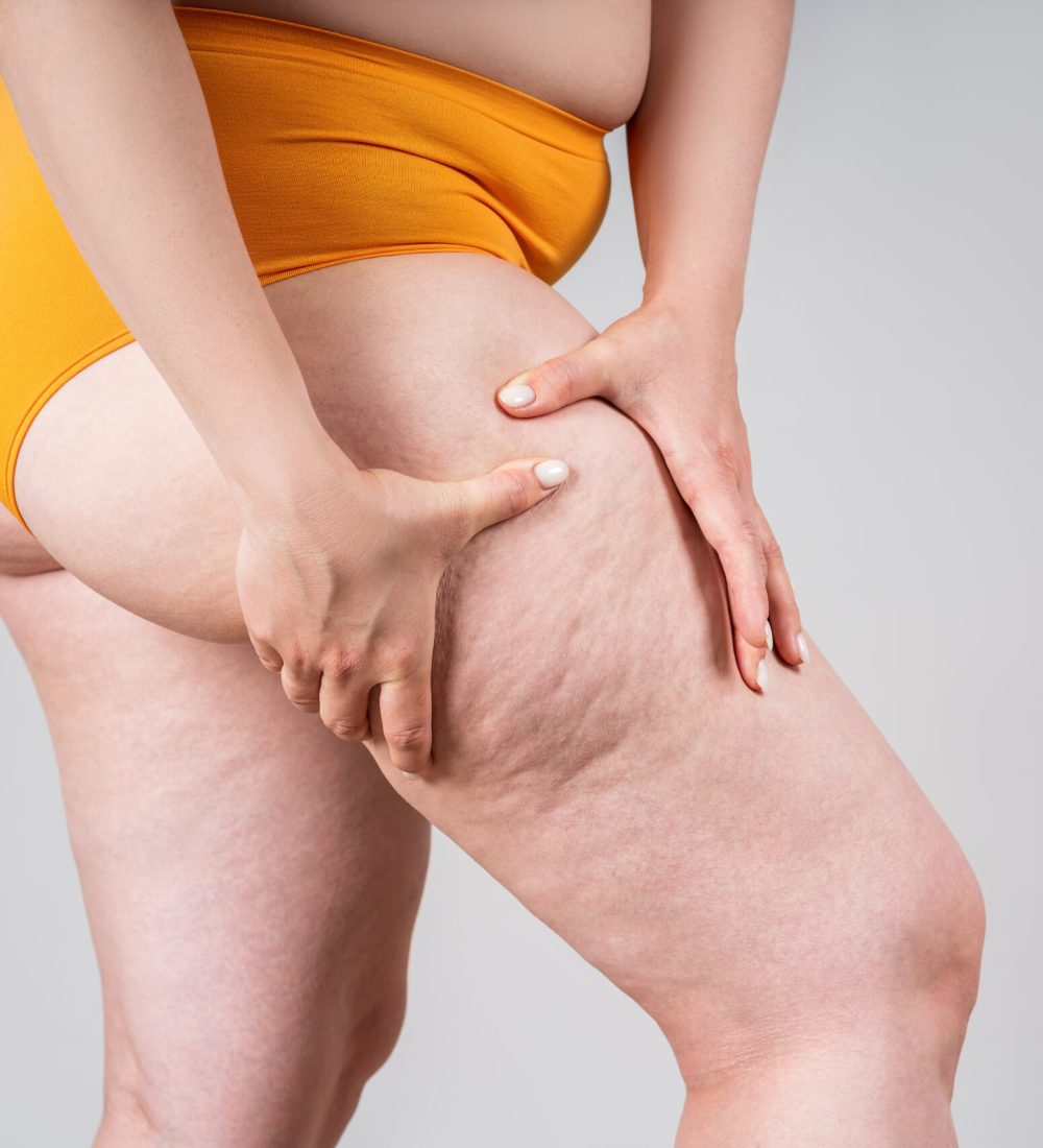 Overweight woman, fat thighs and buttocks, obesity female legs with cellulite on gray background