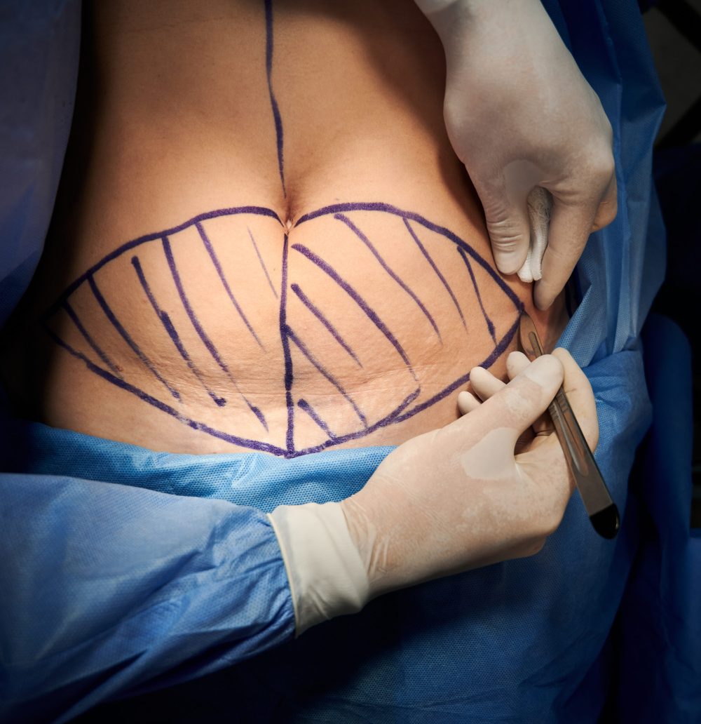 Close up top view of doctor hands using scalpel, doing plastic surgery in operating room. Surgeon cutting patient belly with blue marks on skin. Concept of aesthetic surgery and abdominoplasty.