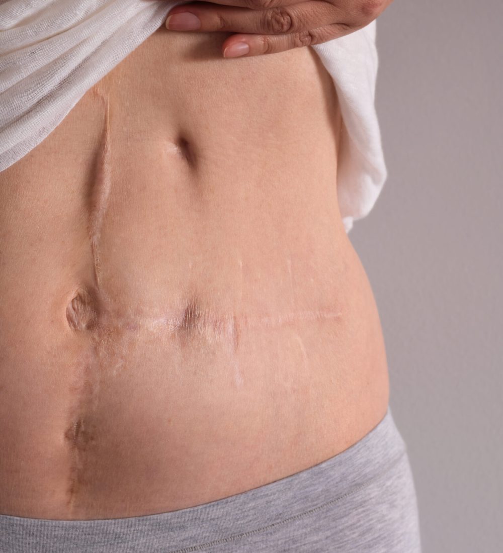 Multiple scars on woman's abdomen from surgery