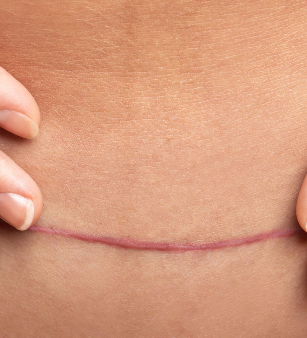 Closeup of scar after C-Section surgery on female belly